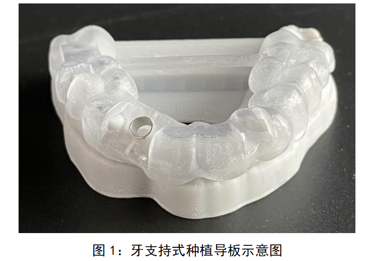 牙科种植用导板注册审查指导原则（征求意见稿）
