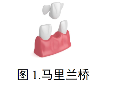 临时冠/桥注册审查指导原则（征求意见稿）
